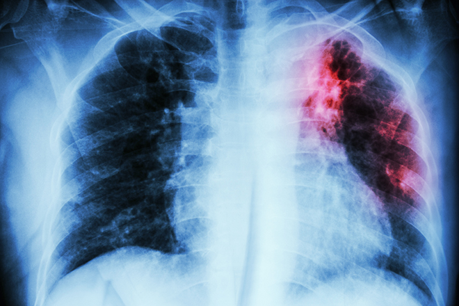 Foto: Aufnahme eines Tuberkulose Röntgenbildes